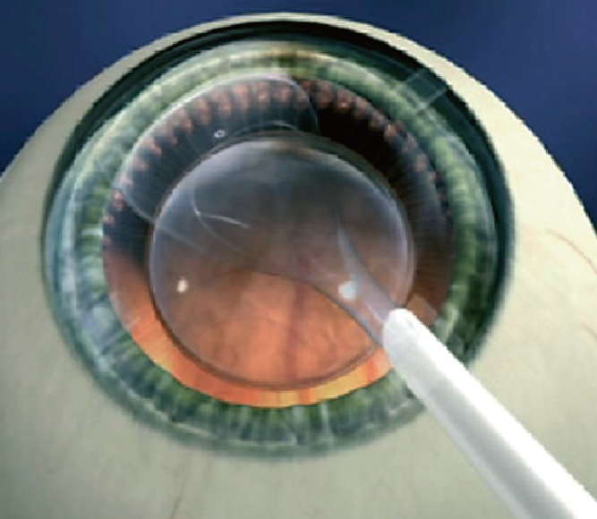 将角膜表面揭起一层薄细胞膜，成一块角膜瓣