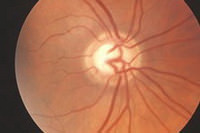 患上青光眼之病者之視神經線頭 - 視杯增大