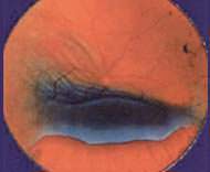 retinal detachment