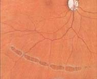 retinal detachment