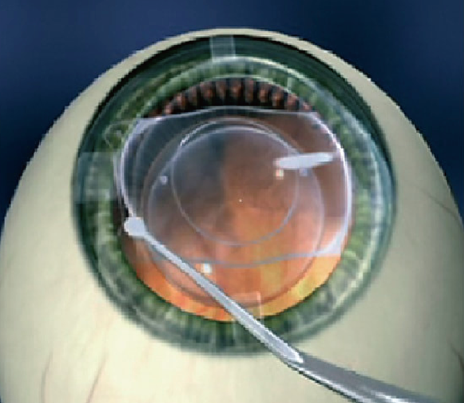 Step 2: Creation of a small incision above or below the eye.