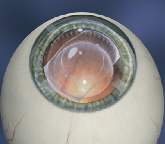 Step 3: Implantation of the ICL lens between the eye's natural crystalline lens and the iris.