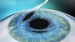A partial thickness lamellar flap of the cornea is created.