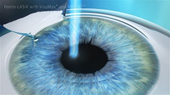 Laser is applied to the underlying stromal bed of the cornea, reshaping as programmed.