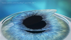 The cornea flap is replaced and heals naturally.