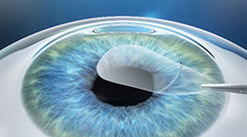 the lenticule is removed via a 2-4 mm small incision