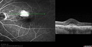 光学同步眼底扫描 (OCT)
