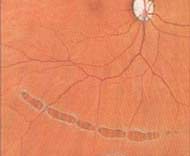 激光巩固视网膜破损治疗前及治疗