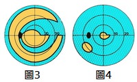 圖中藍色部份為青光眼病人看不清楚之視野範圍