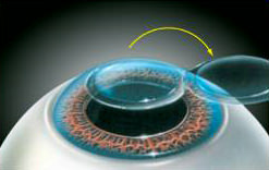 將角膜表面揭起一層薄細胞膜，成一塊角膜瓣